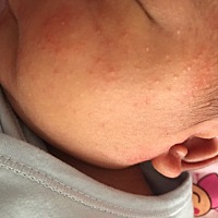 宝宝出生15天了，这两天发现他脸上起了好多疙瘩，有没有懂的宝妈，求帮助