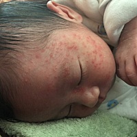 宝宝出生第17天，脸上长了好多脓包疹，宝妈有没有什么好的方法去除