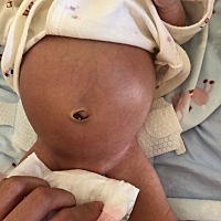 宝宝出生今天第14天，肚子好胀好大，一出生说可能吸羊水了马上送儿科观察，在儿科7天，第八天出院，回来...