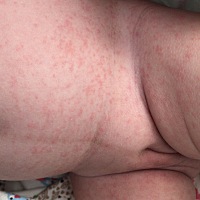 宝妈们知道这是什么嘛？有一样的宝宝吗？拿手一按就没了 放开就又有了，晾一会就好了 吃奶或者一哭就特...