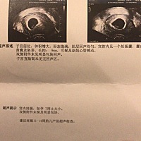 前几天第一次去医院检查的时候，医生都差不多要下班了，匆匆忙忙的去做了b超检查了是宫内。然后医生什么...