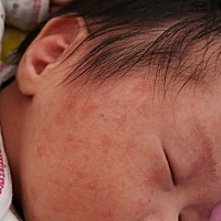 这种是湿疹吗？用点什么药好呢？就脸上有。