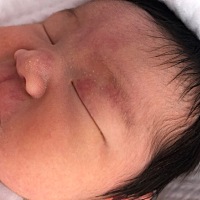 宝宝刚出生额头和眼皮就有红色斑块，有没有宝宝是同样情况的呀，这是胎记还是什么啊。好捉急