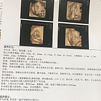 天天担惊受怕的今天四维彩超终于做好了，宝宝一下打哈欠一下踢腿摇摇小手都被我和他爸看到了，四维都很...