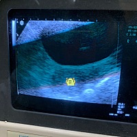 医生说，还在游走没有着床呢～但是能看见是在宫内哈哈哈哈真好 肚子天天跟姨妈疼一样，你们也是吗？但是...