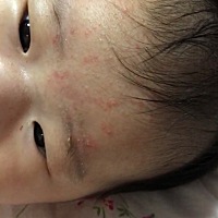 各位宝妈看看我家宝宝脑门上的这些红点是什么东西，还有两天打疫苗  不知道头上有这个红点点能不能打疫...