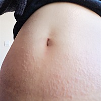 怀孕3个月一直起荨麻疹，不知道有什么办法可以止痒的，难受死了，请大家帮帮我！