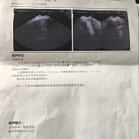 上周的时候b超能见到胎心胎芽了。跟老公结婚好久因为自己多囊一直没能怀孕。本打算下半年去做试管，没想...