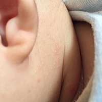 宝宝快4个月了，最近脸上和脖子上长了很多这些小颗粒，请问宝妈们，这些是湿疹还是什么呢？