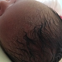 宝宝出生16天了，只在医院给洗过一次澡，然后头上就长这个了，医生不让碰水，一直擦百多邦。有宝妈知道...