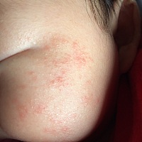 请问宝宝脸上这是湿疹吗？感觉皮肤好粗，要怎么处理呢？