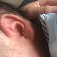 宝宝脸上全是这种小痘痘，耳朵好像发炎了。家里人非说是胎毒，有宝妈认识的吗？怎么能好？已经好多天了