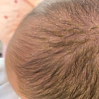 宝宝头上长了好多咖，好像是乳痂，出生时没有，刚长得，痒的的不行，小手都给挠红了[捂脸]，宝妈们都是...