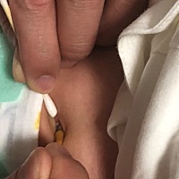 宝宝脐茸有什么办法吗，不要手术