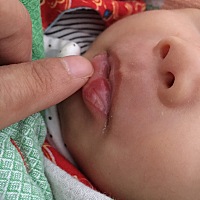 宝宝从出院到现在嘴巴就没好，有知道是什么原因吗，谢谢🙏很担心