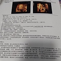 四维终于过了，可室间隔连续中断1.8mm又是什么意思，好担心，有懂的宝妈吗？急急急！！！！！