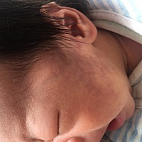 宝宝18天了，脸上这块到底是胎记还是产道挤压所致啊，一点都没有消，好着急哦，有宝妈知道么