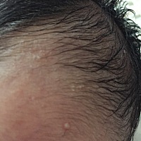 这起的白白的小疙瘩是什么，哪位遇到过，怎么处理