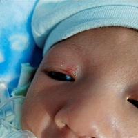 请问各位宝妈们  宝宝眼角的是胎记还是什么出生就有的到现在都没有消 不哭的时候淡淡的一哭就很红