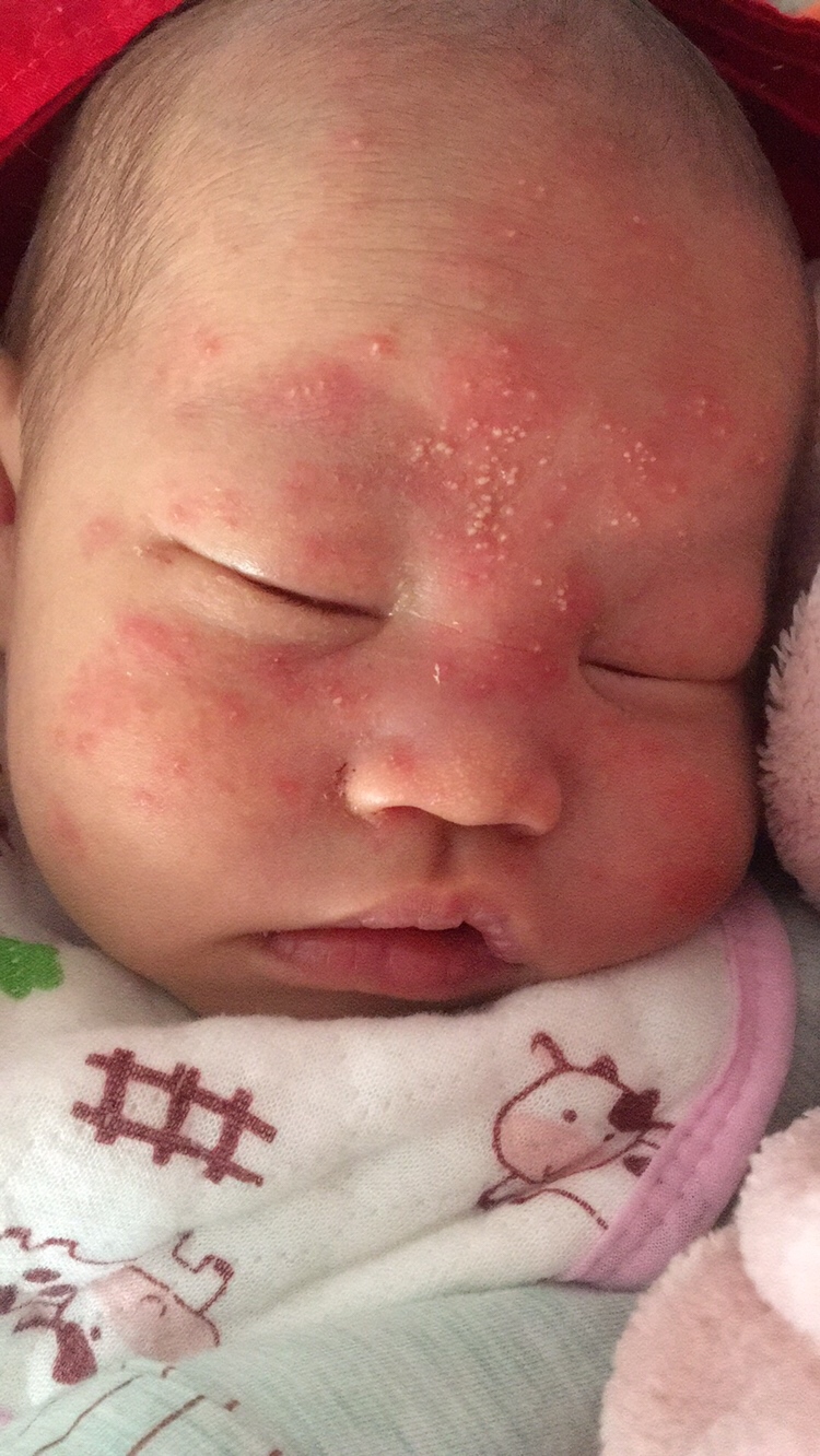 宝宝脸上长了好多这种。前几天不多 现在越来越多了。老公舅舅是医生 他老说没事  感觉太吓人了 睡一觉脸上又多了 看着都难受😣