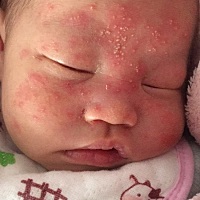 宝宝脸上长了好多这种。前几天不多 现在越来越多了。老公舅舅是医生 他老说没事  感觉太吓人了 睡一觉脸...