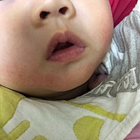 我女儿刚刚有口水疹了，宝妈们有什么好用的口水疹药膏推荐吗？