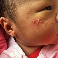 宝宝脸上起了好多，有知道用什么办法才能消失的啊。