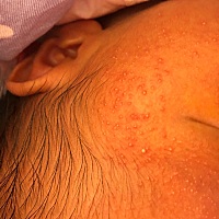 有宝妈知道这个湿疹怎么好吗？去医院看了2次了，医生说没什么，也拿了药膏，可是还在长，而且越长越多，...