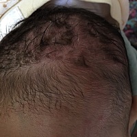 请问头上长的这个是湿疹导致的吗？宝宝头皮一直都好痒的，还有黄色的液体流出，头发也不能剃，要不要去...