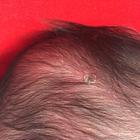 15天宝宝后脑有块红然后结白痂了，谁知道怎么回事？