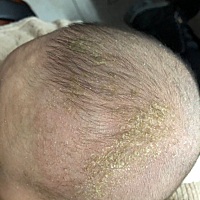 每天用润肤油软化了洗了结果第二天又长回来了，各种查说是湿疹引起的，宝妈们有没有激素的药膏推荐。看...