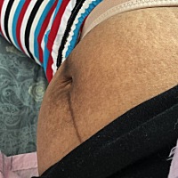 有同款顺产后肚子吗，有没有什么好用方法把黑色素消灭掉😩