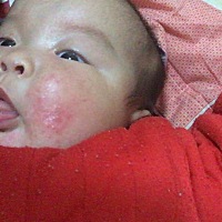 各位宝妈，请问宝宝这是什么引起的，擦茶油没用，擦进口药膏也没用