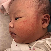 宝宝脸上是不是湿疹，有没有一样的宝妈分享一下经验该怎么治啊？十几天了，一直没，急死了
