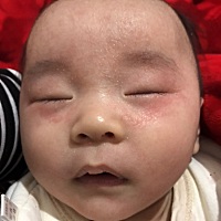 宝宝湿疹一个多月叻，好不容易好了一个礼拜，昨天到今天这个样子，比之前还要严重，好心疼，我这种玻璃...