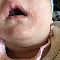 这个是湿疹吗？宝宝脸上突然冒出来的