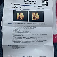 今天做了三维，左侧测脑后角1.0正常吗？