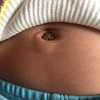 孩子肚脐你们是怎么护理的呀。我每天用碘伏消毒。第二天还是会结痂。 还是不用管。让他自己掉呀