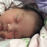 我家宝宝出生眼皮上就有红色的印记，听说是会慢慢褪去的，9天了没有淡化，请问有没相同宝宝已经褪去了的...