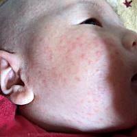 宝宝一个多月，脸上出了好多疙瘩，是怎么回事？