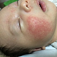 我崽脸上长得是湿疹吗，有经验的宝妈们支支招，谢谢🙏