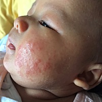 反反复复，终于好了✌🏻