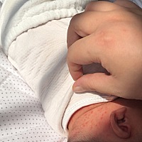 宝宝这是不是湿疹啊，就这一遍严重