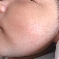 二月婴儿脸上这是怎么回事、擦了面霜不管用……维肤露还是这样.有什么好建议