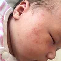 宝宝25天 脸上都是痘痘