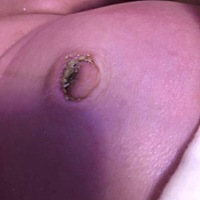 有过这样肚脐的宝宝吗，不知道这样要不要紧，好担心，都突出来了