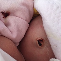 宝贝十二天了，肚脐带本来掉了，后来又有点出血，有没有宝妈知道这个该用点什么药吗