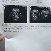 昨天做的B超双胞胎发育都说很好，可是昨天早上起来上厕所一看吓死了出血了，擦了2张卫生纸都有血，后面...
