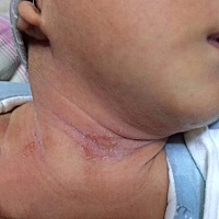 宝宝脖子上起一些小水泡，破了流一些黄色的脓水，每天都给擦拭抹爽身粉，这是什么引起的？涂完爽身粉还...