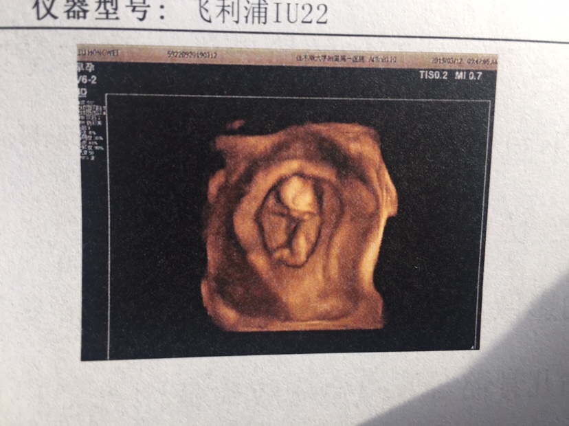 12＋3  NT正常
看到他的一瞬间，我的心都化了